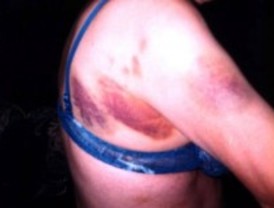 Calidad de los partes de lesiones en casos de violencia de género