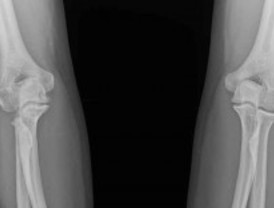 Un tratamiento satisfactorio para algunas fracturas del codo