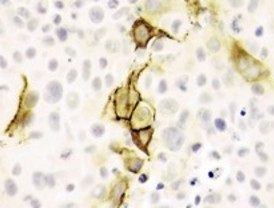 Nueva terapia génica para tratar varios tipos de cáncer con yodo radiactivo