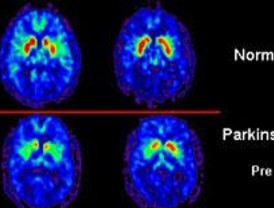 La ira en la enfermedad de Parkinson