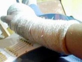SERMAS pagará 15.000 euros a un menor por escayolarle el brazo incorrectamente
