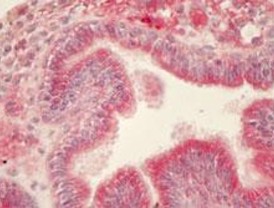 El oncogen PCPH participa en la progresión de los tumores de próstata
