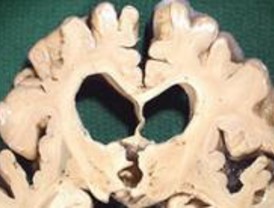 El sistema Cogknow proporcionará mayor autonomía a los enfermos de Alzheimer