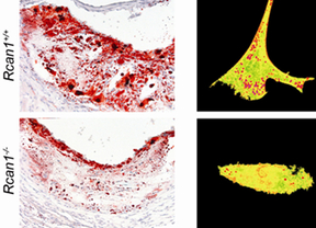 La eliminación genética de Rcan1 disminuye la acumulación de colesterol LDL