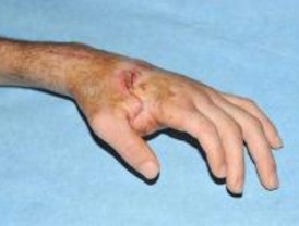 El 12 de Octubre logra el primer implante de una mano amputada en otra