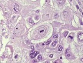 Relacionan el acortamiento de los telómeros con el cáncer de pulmón