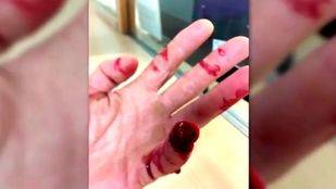 Un conductor arranca un dedo a un policía de un mordisco