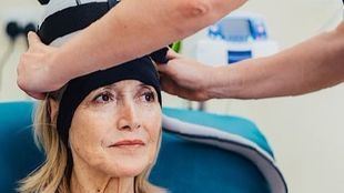 Un innovador tratamiento reduce la alopecia en pacientes con cáncer