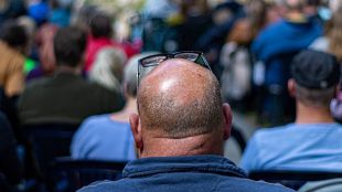 Láser capilar: la solución para la caída del pelo
