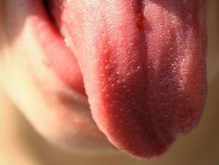 Un estudio español encuentra nuevos síntomas del covid: aumento del tamaño de la lengua y otras lesiones