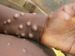 Los casos de viruela del mono confirmados en la Comunidad de Madrid son ya 443