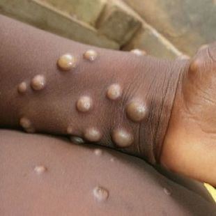 Primer fallecido por viruela del mono confirmado en España