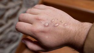 Confirmada la segunda muerte por viruela del mono en España