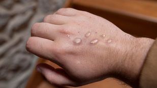 Primer día desde mayo sin nuevos casos de viruela del mono en la Comunidad