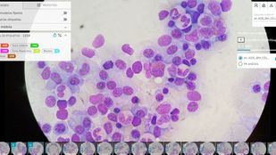Inteligencia Artificial para el tratamiento y pronóstico de enfermedades hematológicas