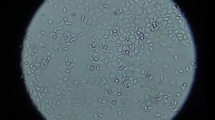 Investigadores españoles descubren una nueva vía para debilitar el cáncer de páncreas