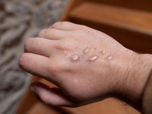 Detectado el primer caso importado de viruela del mono tipo clado 1b en la región