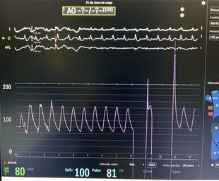 El Hospital de Torrejón reduce a la mitad el reingreso de pacientes con insuficiencia cardiaca