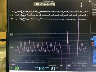 El Hospital de Torrejón reduce a la mitad el reingreso de pacientes con insuficiencia cardiaca