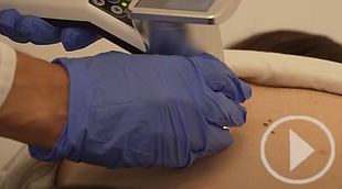 VECTRA360, una esperanza para el pronóstico del cáncer de piel