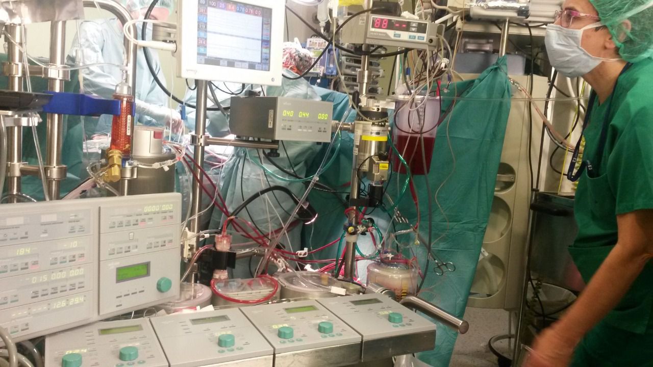 Máquina de circulación extracorpórea durante el trasplante. 
