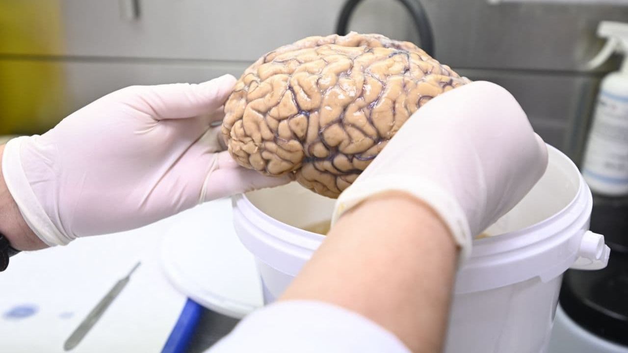 Uno de los cerebros donados en manos de Alberto Rábano