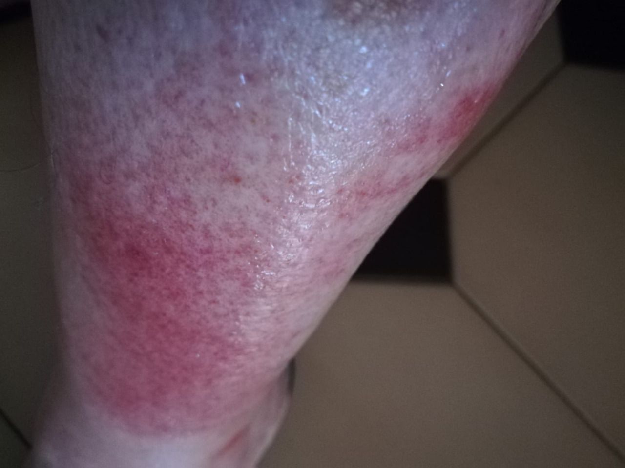 Reacción a la mordedura de un mosca negra (Foto: Juan Pablo Ruiz)