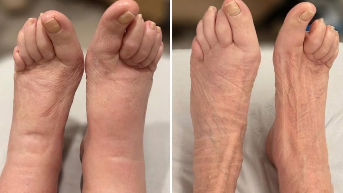 Piernas inflamadas y el resultado tras el tratamiento de fisioterapia